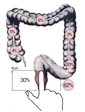 kolorektalnyi_rak2.jpg kolorektalnyi_rak2.jpg